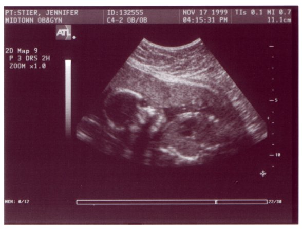 Ultrasound Picture No. 6